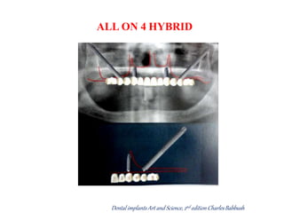 ALL ON 4 HYBRID
Dental implantsArt and Science,2nd editionCharlesBabbush
 