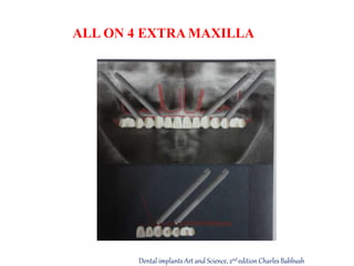 ALL ON 4 EXTRA MAXILLA
Dental implants Art and Science, 2nd edition CharlesBabbush
 