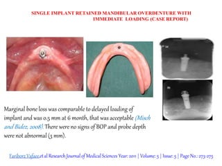 SINGLE IMPLANT RETAINED MANDIBULAR OVERDENTURE WITH
IMMEDIATE LOADING (CASE REPORT)
Marginal bone loss was comparable to delayed loading of
implant and was 0.5 mm at 6 month, that was acceptable (Misch
and Bidez, 2008). There were no signs of BOP and probe depth
were not abnormal (3 mm).
Fariborz Vafaee,etal ResearchJournal of Medical Sciences Year: 2011 | Volume: 5 | Issue: 5 | Page No.: 273-275
 