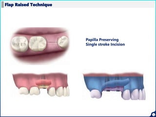 15
Flap Raised Technique
Papilla Preserving
Single stroke Incision
 
