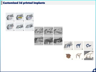 Customized 3d printed implants
29
 