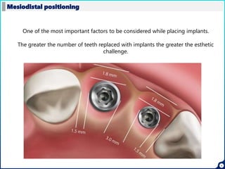 9
Mesiodistal positioning
One of the most important factors to be considered while placing implants.
The greater the number of teeth replaced with implants the greater the esthetic
challenge.
 