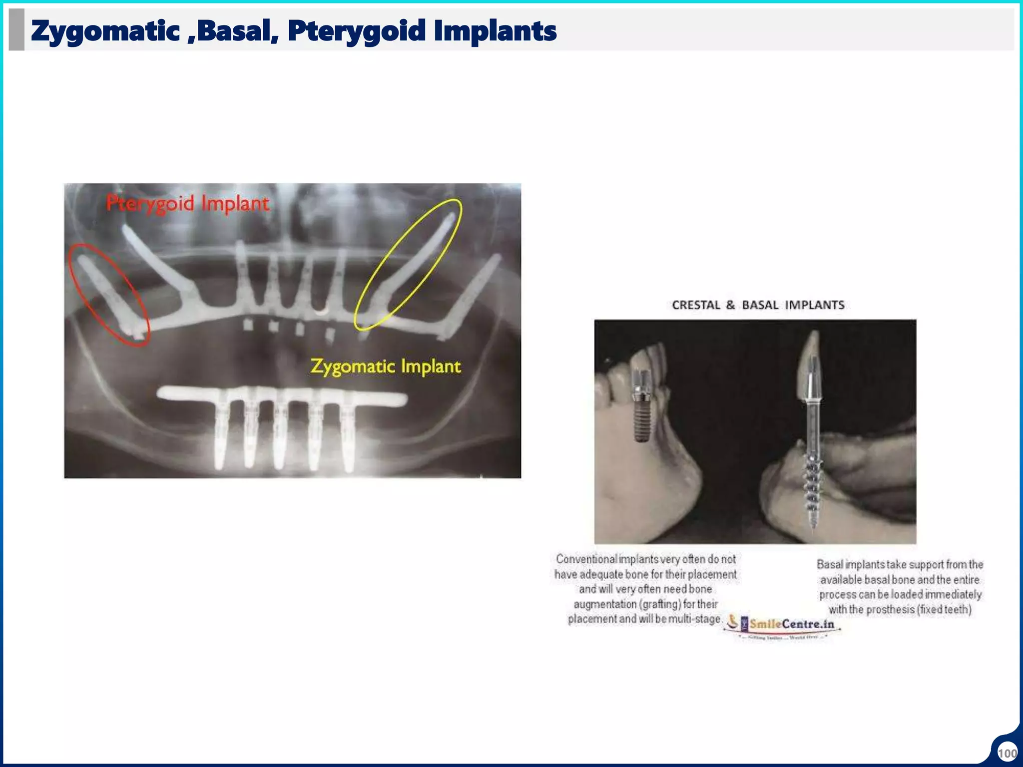 Zygomatic ,Basal, Pterygoid Implants
100
 