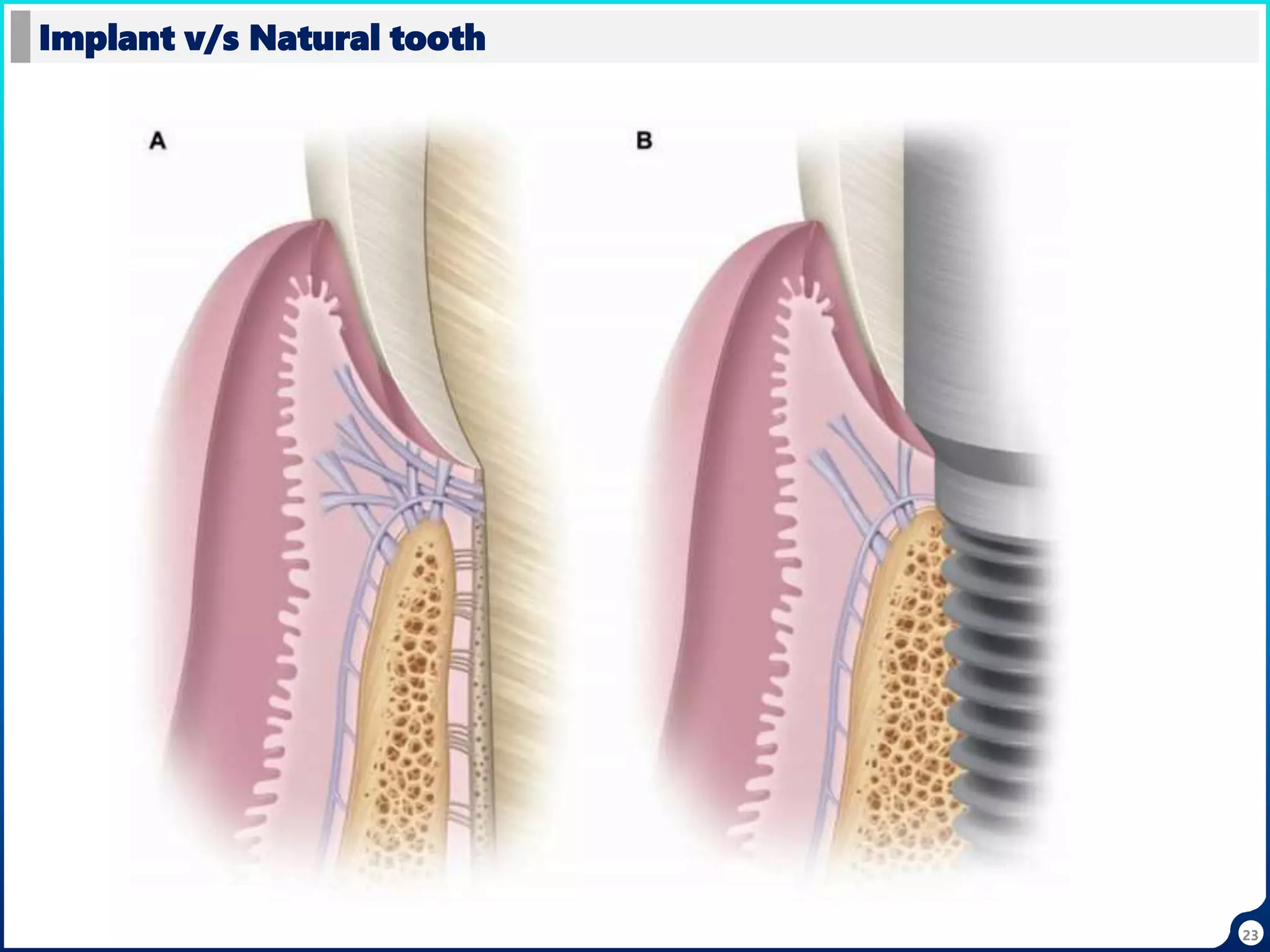 23
Implant v/s Natural tooth
 