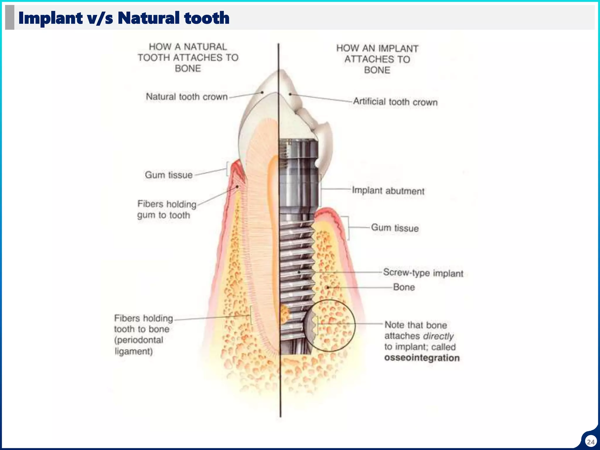 24
Implant v/s Natural tooth
 