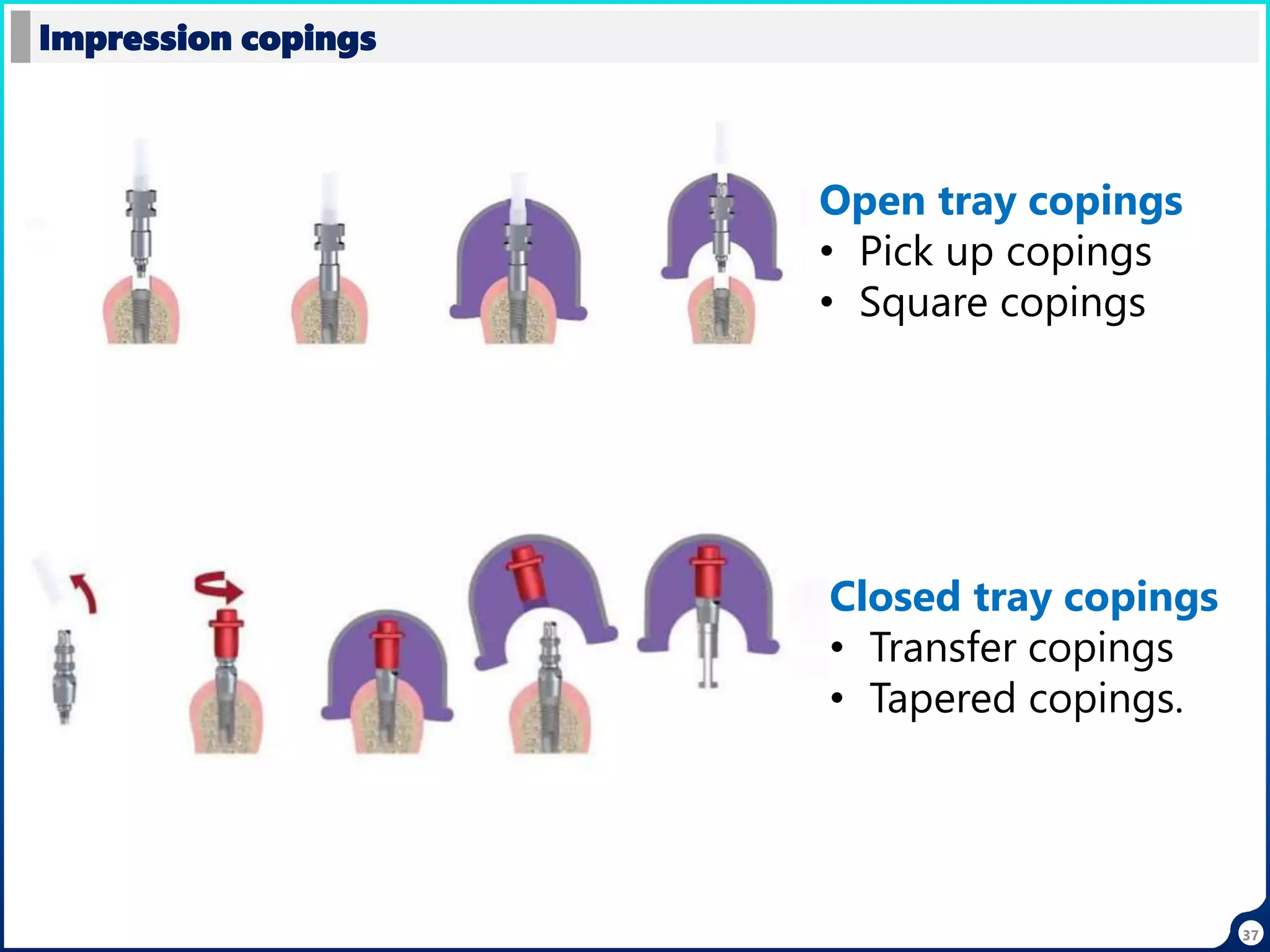 37
Open tray copings
• Pick up copings
• Square copings
Closed tray copings
• Transfer copings
• Tapered copings.
Impression copings
 
