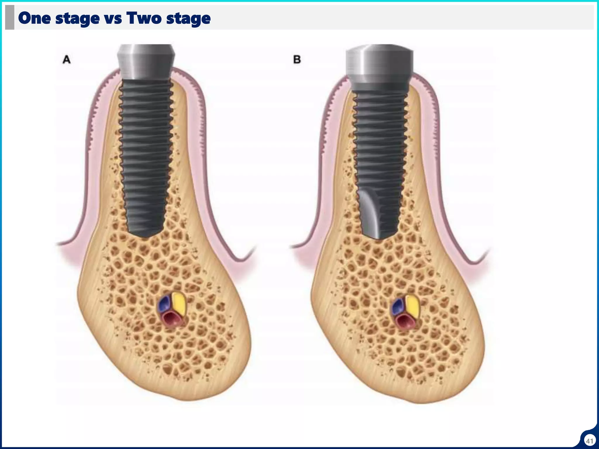 41
One stage vs Two stage
 