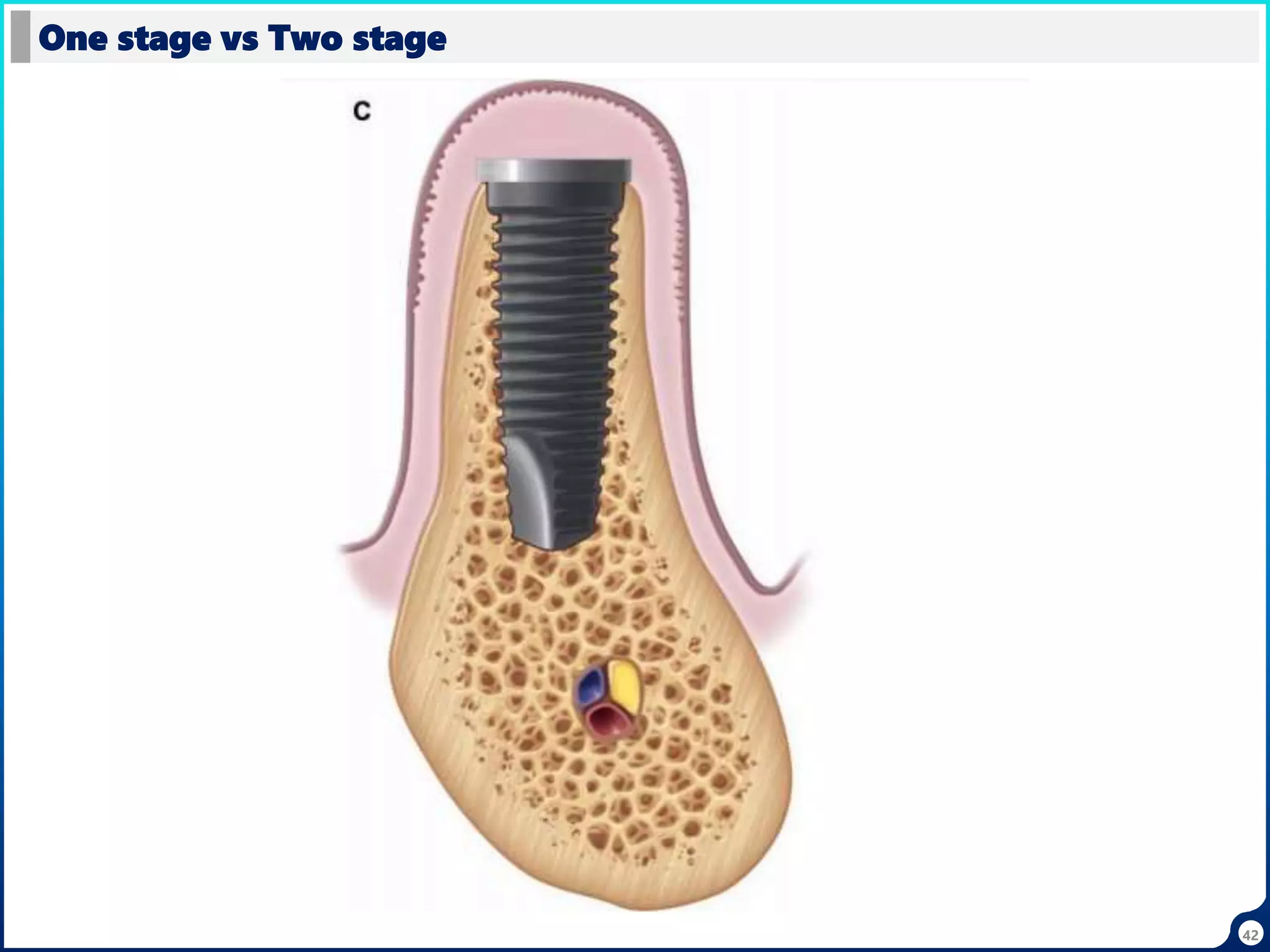 42
One stage vs Two stage
 