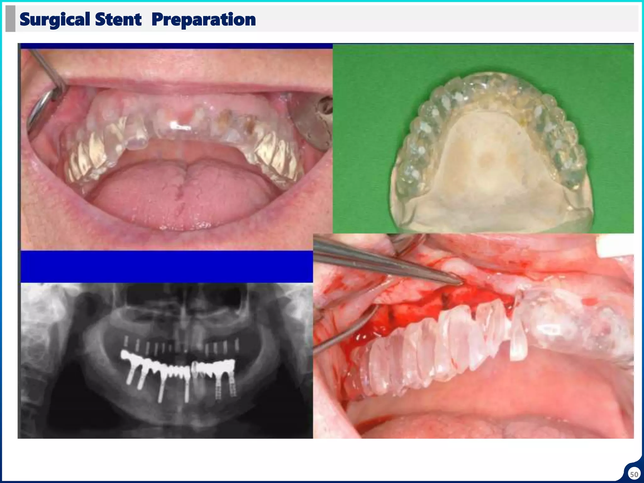 50
Surgical Stent Preparation
 