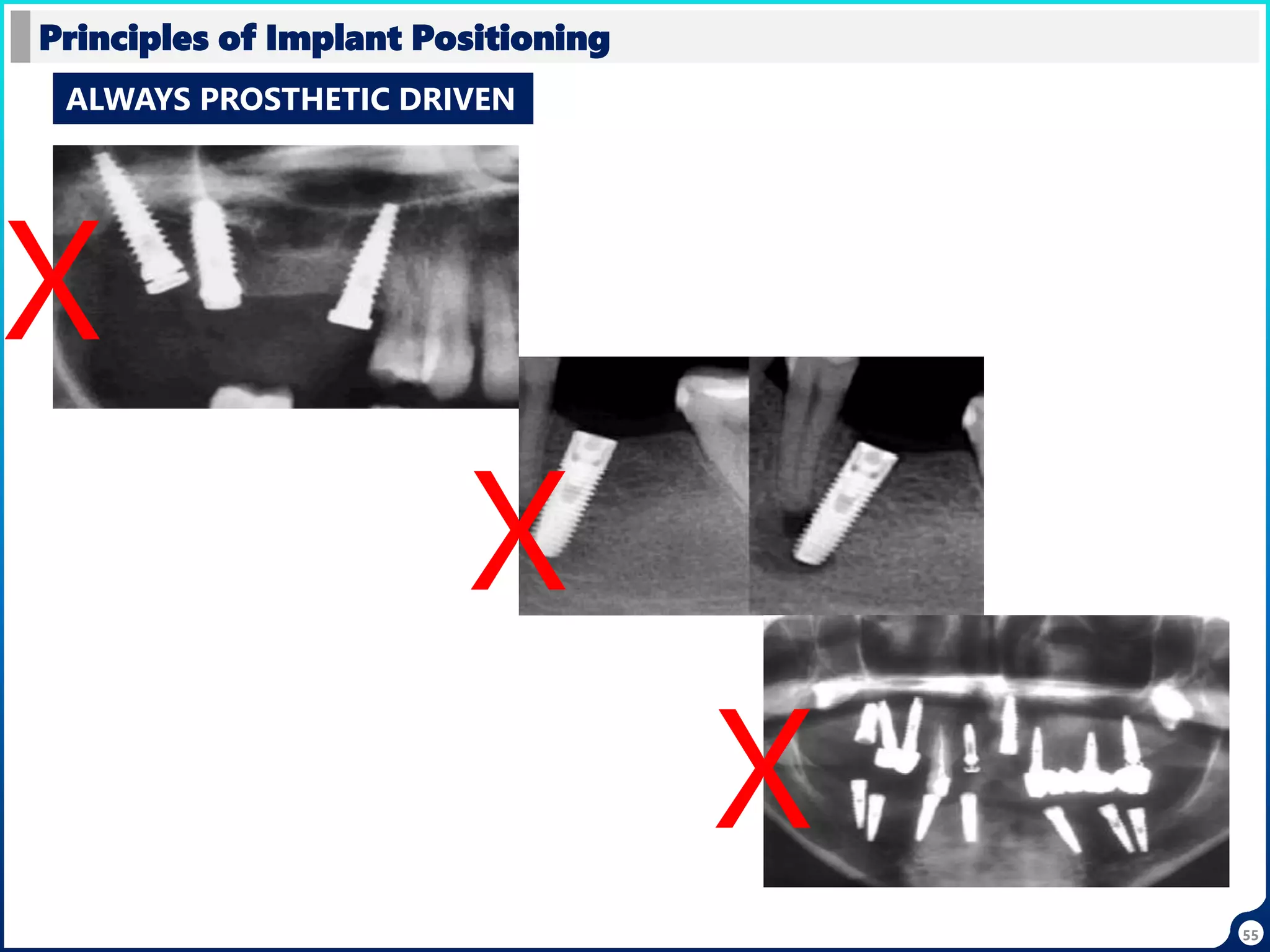 55
Principles of Implant Positioning
ALWAYS PROSTHETIC DRIVEN
X
X
X
 