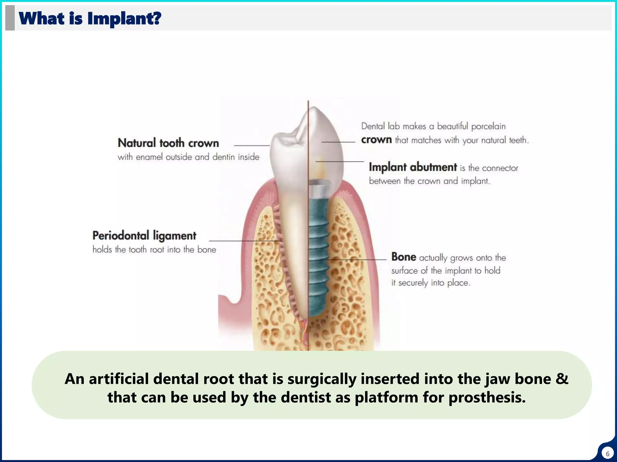What is Implant?
An artificial dental root that is surgically inserted into the jaw bone &
that can be used by the dentist as platform for prosthesis.
6
 