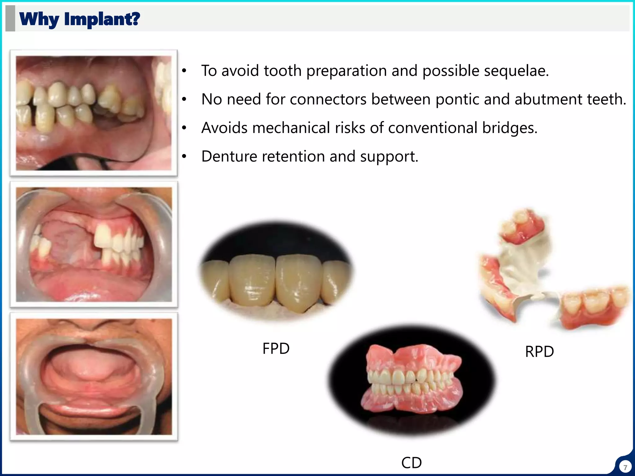 7
Why Implant?
• To avoid tooth preparation and possible sequelae.
• No need for connectors between pontic and abutment teeth.
• Avoids mechanical risks of conventional bridges.
• Denture retention and support.
FPD RPD
CD
 