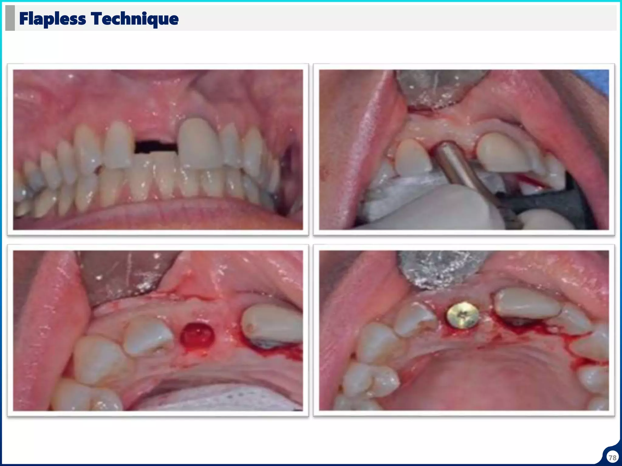 78
Flapless Technique
 