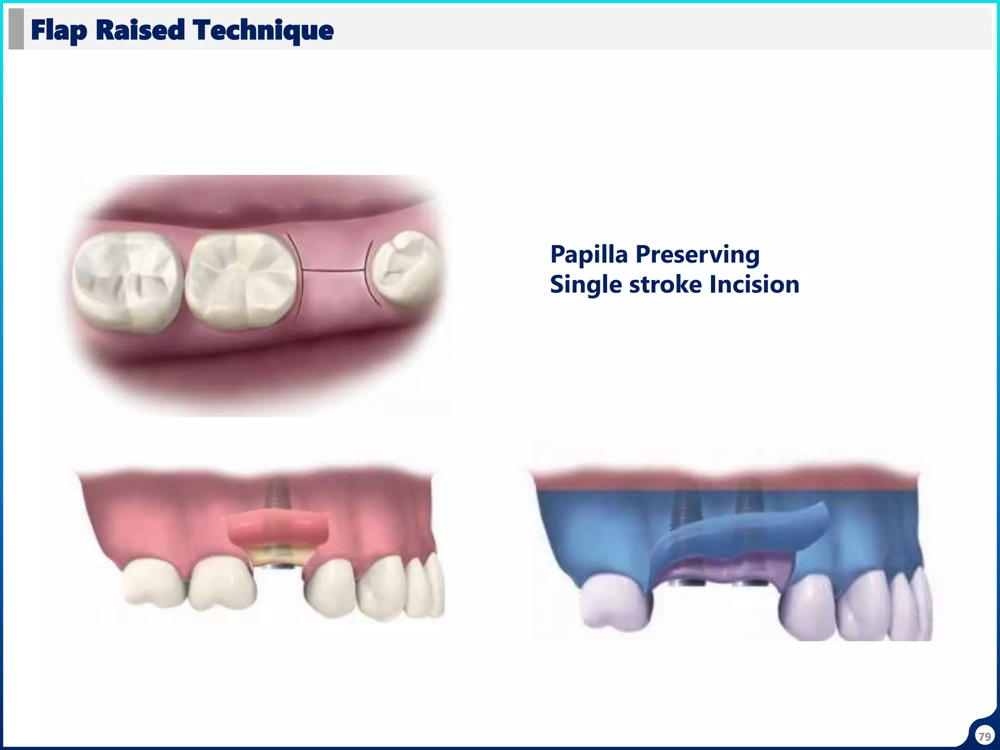 79
Flap Raised Technique
Papilla Preserving
Single stroke Incision
 
