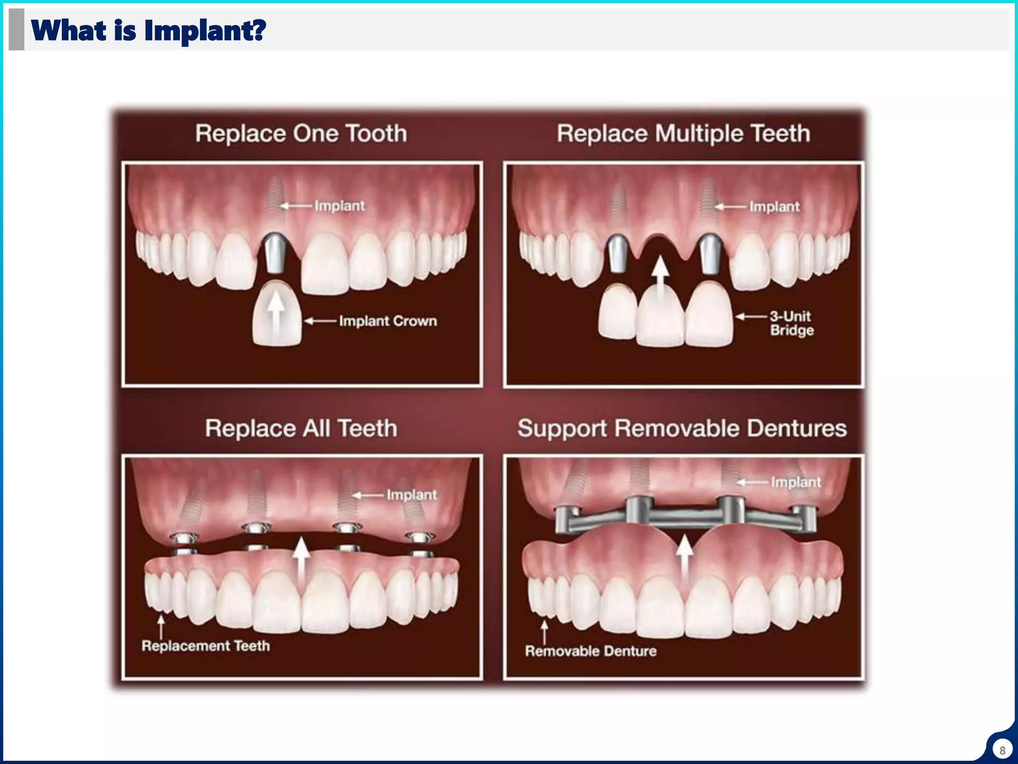 8
What is Implant?
 
