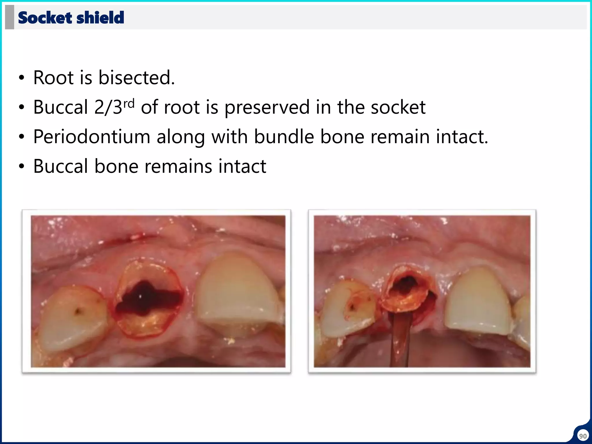 • Root is bisected.
• Buccal 2/3rd of root is preserved in the socket
• Periodontium along with bundle bone remain intact.
• Buccal bone remains intact
Socket shield
90
 