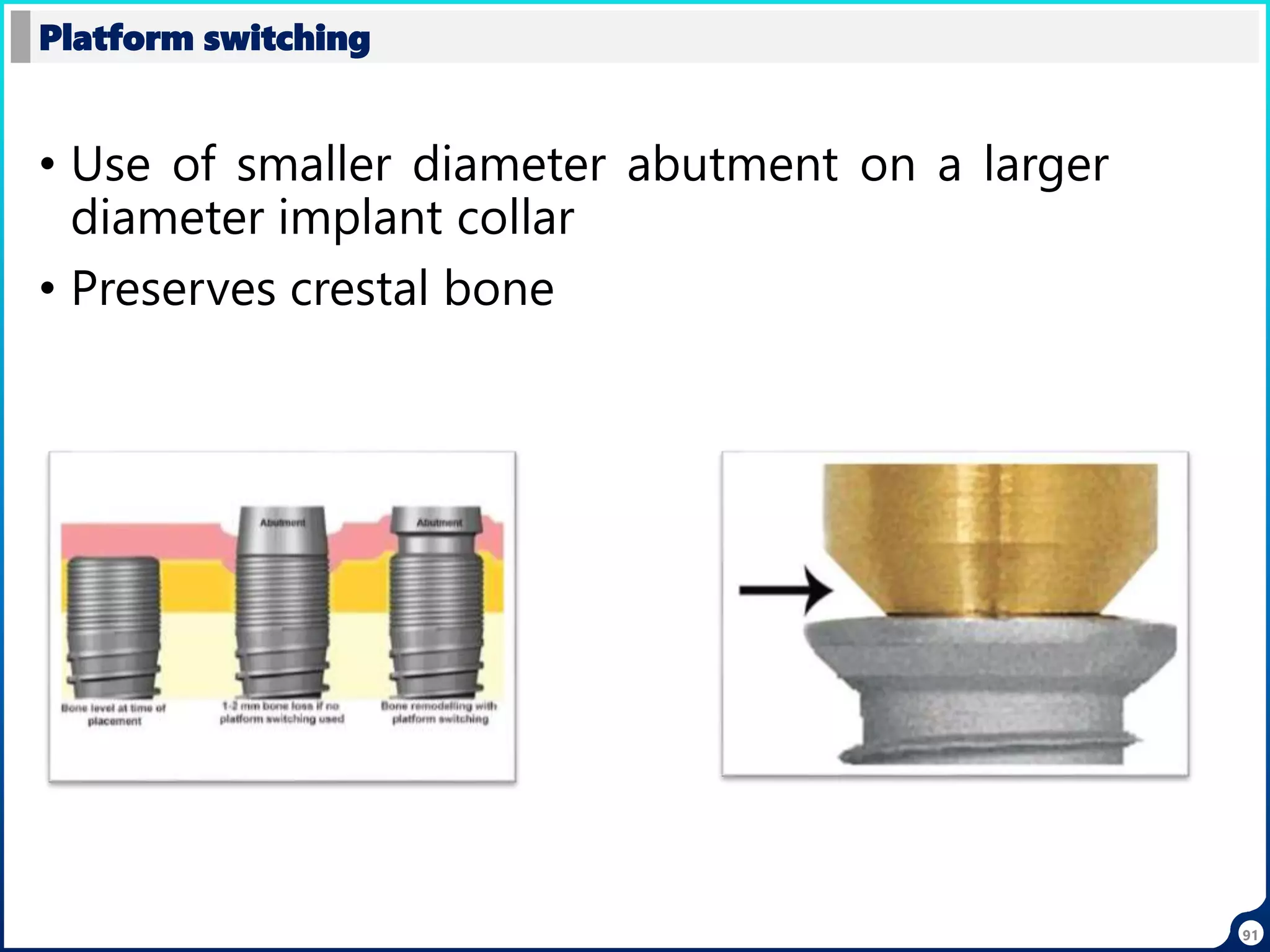 • Use of smaller diameter abutment on a larger
diameter implant collar
• Preserves crestal bone
Platform switching
91
 