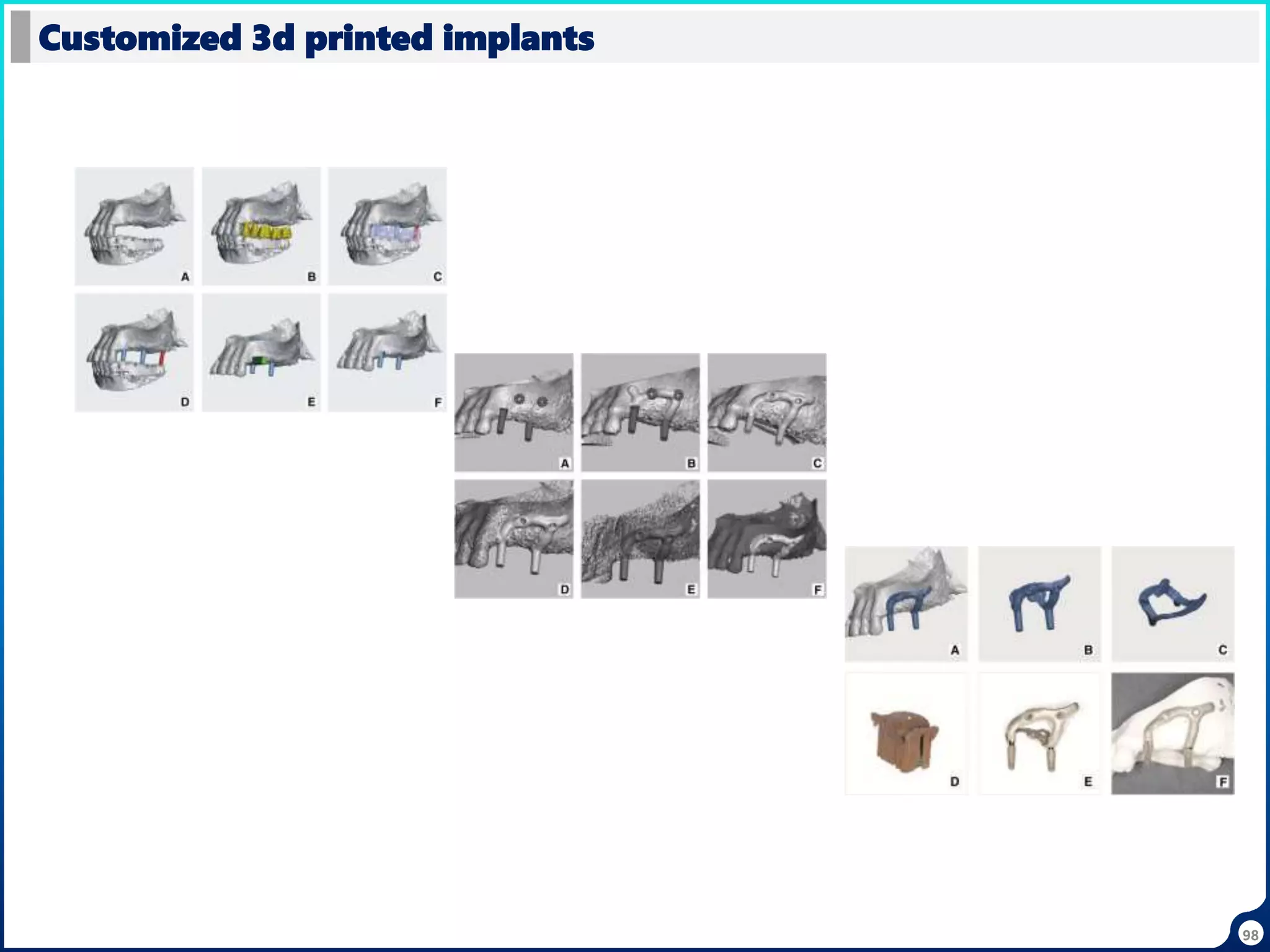 Customized 3d printed implants
98
 