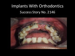 Implants With Orthodontics 
Success Story No. 2146  