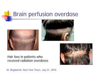 Brain perfusion overdose
Hair loss in patients who
received radiation overdoses
W. Bogdanich, New York Times, July 31, 2010
 