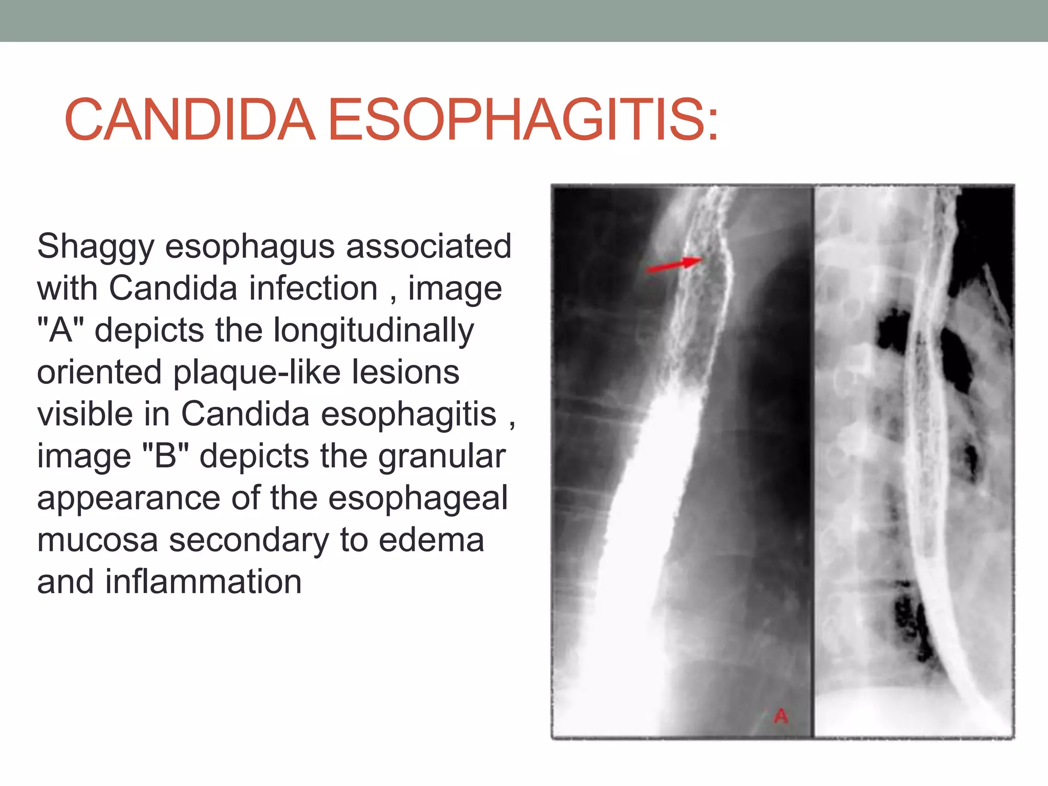 barium studies in gi pathologies | PPTX