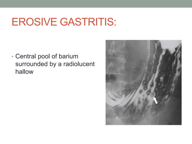 barium studies in gi pathologies | PPTX | Digestive Disorders ...