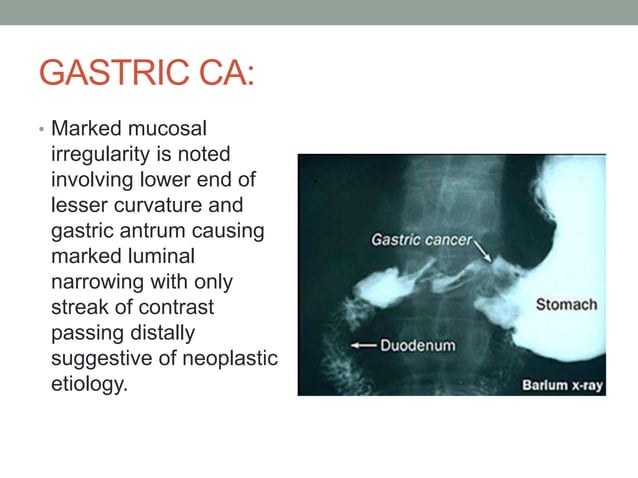 barium studies in gi pathologies | PPTX | Digestive Disorders ...
