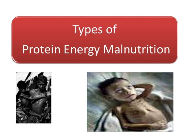 importance of nutrition cmoh bankura protein energy malnutrition