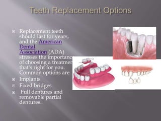  Replacement teeth
should last for years,
and the American
Dental
Association (ADA)
stresses the importance
of choosing a treatment
that's right for you.
Common options are
 Implants
 Fixed bridges
 Full dentures and
removable partial
dentures.
 