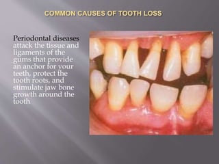 COMMON CAUSES OF TOOTH LOSS
Periodontal diseases
attack the tissue and
ligaments of the
gums that provide
an anchor for your
teeth, protect the
tooth roots, and
stimulate jaw bone
growth around the
tooth.
 