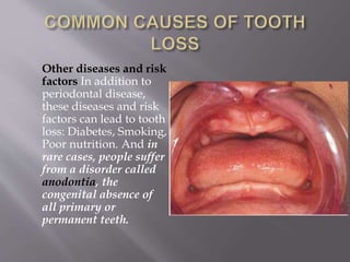 Other diseases and risk
factors In addition to
periodontal disease,
these diseases and risk
factors can lead to tooth
loss: Diabetes, Smoking,
Poor nutrition. And in
rare cases, people suffer
from a disorder called
anodontia, the
congenital absence of
all primary or
permanent teeth.
 