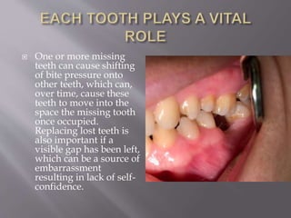  One or more missing
teeth can cause shifting
of bite pressure onto
other teeth, which can,
over time, cause these
teeth to move into the
space the missing tooth
once occupied.
Replacing lost teeth is
also important if a
visible gap has been left,
which can be a source of
embarrassment
resulting in lack of self-
confidence.
 