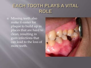  Missing teeth also
make it easier for
plaque to build up in
places that are hard to
clean, resulting in
gum infections that
can lead to the loss of
more teeth.
 