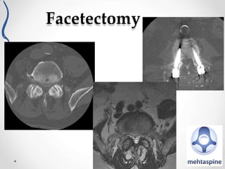 Importance of the sagittal profile in spinal deformity surgery | PPTX