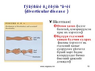 Гýäýñíèé ö¿ëõýíò ºâ÷èí  (diverticular disease )   Шалтгаан:  Өтгөн хатах   ( эслэг багатай, цэвэршүүлсэн хүнс их хэрэглэх ) Бүдүүн гэдэсний ханын булчин сулрах   ( махны хэрэглээ нь гэдэсний ханыг сулруулах үйлчлэл бүхий хорт бодис ялгаруулдаг бичил биетний үржлийг дэмждэг ) www.vegesos.mn 