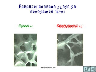 Êàëüöèéí äóòëààñ ¿¿ñýõ ÿñ  ñèéðýãæèõ ºâ÷èí  Õýâèéí  яс Ñèéðýãæñýí  яс www.vegesos.mn 