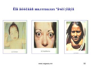 Èîä äóòëààñ  шалтгаалах  ºâ ч èí ýìãýã www.vegesos.mn 