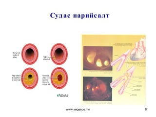 Судас нарийсалт www.vegesos.mn 