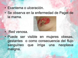 • Exantema o ulceración.
• Se observa en la enfermedad de Paget de
la mama.
• Red venosa.
• Puede ser visible en mujeres o...