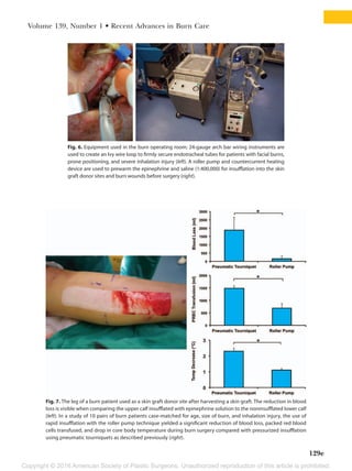 Copyright © 2016 American Society of Plastic Surgeons. Unauthorized reproduction of this article is prohibited.
Volume 139, Number 1 • Recent Advances in Burn Care
129e
Fig. 6. Equipment used in the burn operating room; 24-gauge arch bar wiring instruments are
used to create an Ivy wire loop to firmly secure endotracheal tubes for patients with facial burns,
prone positioning, and severe inhalation injury (left). A roller pump and countercurrent heating
device are used to prewarm the epinephrine and saline (1:400,000) for insufflation into the skin
graft donor sites and burn wounds before surgery (right).
Fig. 7. The leg of a burn patient used as a skin graft donor site after harvesting a skin graft. The reduction in blood
loss is visible when comparing the upper calf insufflated with epinephrine solution to the noninsufflated lower calf
(left). In a study of 10 pairs of burn patients case-matched for age, size of burn, and inhalation injury, the use of
rapid insufflation with the roller pump technique yielded a significant reduction of blood loss, packed red blood
cells transfused, and drop in core body temperature during burn surgery compared with pressurized insufflation
using pneumatic tourniquets as described previously (right).
 