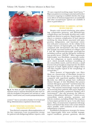 Copyright © 2016 American Society of Plastic Surgeons. Unauthorized reproduction of this article is prohibited.
Volume 139, Number 1 • Recent Advances in Burn Care
131e
centers151
but is currently in further U.S. Food and
Drug Administration–regulated clinical trials.
BURN WOUND CLOSURE: FACIAL
TRANSPLANTATION
Vascularized composite allotransplantation of
the face represents a new reconstructive avenue
for patients with disfiguring full-face injuries, with
10 cases reported involving major facial burns.152
Rigorous patient screening is essential and further
research is ongoing to establish whether the long-
term effects of immunosuppression are justifiable
and what reconstructive options are available if
there is graft failure.153
HYPERTROPHIC SCARRING AFTER
BURN INJURY
Despite early wound resurfacing, joint splint-
ing, compression garments, and physiotherapy,
complications may inevitably develop and confer
significant distress to patients. Hypertrophic scar-
ring is a common complication of burn injuries
involving the deep dermis associated with pain,
pruritus, disfiguration, and functional restric-
tion with joint contractures. At the cellular level,
unique features of hypertrophic scar fibroblasts
compared with site-matched cells from normal
skin include increased synthesis of collagen types
I and III, high-molecular-weight proteoglycans
including versican, and the fibrogenic transform-
ing growth factor (TGF)-β.154
More importantly,
hypertrophic scar fibroblasts consistently synthe-
size less collagenase or matrix metalloprotein-
ase-1, which normally facilitates remodeling of
the extracellular matrix, and less decorin, a small
leucine-rich proteoglycan important for the fibril-
logenesis of small, tightly packed collagen fibers
and fiber bundles typical of the morphology of
normal skin.155
These features of hypertrophic scar fibro-
blasts are characteristic of fibroblasts located in
the deeper layers of the skin or reticular dermis
compared with superficial papillary fibroblasts.
Recently, two different groups have reaffirmed
distinct lineages of skin fibroblasts that possess
intrinsic fibrogenic potential154
and determine the
ultimate dermal architecture after wound heal-
ing.156
The systemic immunologic response typical
of recovering burn patients with severe hypertro-
phic scarring includes a polarized T-helper cell 2
environment157
that also promotes the differen-
tiation of blood-borne fibrocytes,156
which secrete
extracellular matrix proteins, proteases, and
fibrotic cytokines, including TGF-β. This response
to burn injury persists for up to 1 year after burn
injury. Thus, reconstruction of patients with large
burns and limited skin donor sites is best delayed
where possible, until resolution of the systemic
inflammatory response.
Established management strategies for imma-
ture hypertrophic burn scars include massage,
topical emollients, pressure garments, silicone
Fig. 8. The Meek skin graft meshing approach to skin graft
expansion using 4:1 expansion illustrating the nylon mesh car-
rying the micrografts to the patient’s arm and back at 1 week
(above), 1 month (center), and 3 months postoperatively (below).
 