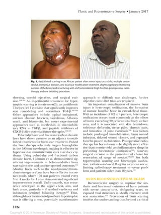 Copyright © 2016 American Society of Plastic Surgeons. Unauthorized reproduction of this article is prohibited.
132e
Plastic and Reconstructive Surgery • January 2017
sheeting, steroid injections, and surgical exci-
sion.158–161
An experimental treatment for hyper-
trophic scarring is interferon-α2b, an antifibrotic
T-helper cell 1 cytokine that significantly improves
scar remodeling and normalizes TGF-β.162–164
Other approaches include topical imiquimod,
calcium channel blockers, tacrolimus, 5-fluoro-
uracil, and bleomycin, but newer experimental
approaches such as interleukin-10, microinhibi-
tory RNA to TGF-β, and peptide inhibitors of
CXCR4 offer potential future therapies.155,165
Pulsed-dye laser and fractional carbon dioxide
laser have shown promise as an adjunct to estab-
lished treatments for burn scar treatment. Pulsed
dye laser therapy selectively targets hemoglobin
in the 585-nm wavelength, making it effective in
hypervascular immature burn scars to reduce ery-
thema. Using pulsed-dye and fractional carbon
dioxide lasers, Hultman et al. demonstrated sig-
nificant improvements in before-and-after burn
scar scale scores and patient-reported outcomes.166
Ablative lasers such as the neodymium:yttrium-
aluminum-garnet laser have been effective in con-
tact mode, where 102 scar patients treated every
3 to 4 weeks for 1 year demonstrated significant
improvements overall. Unfortunately, scar recur-
rence developed in the upper chest, arm, and
back areas, particularly if residual erythema and
induration persisted following therapy.167
Thus,
althoughlasertreatmentofpostburnhypertrophic
scar is offering a new, potentially transformative
approach to difficult scar challenges, further
objective controlled trials are required.
An important complication of massive burn
injury is heterotopic ossification, the formation
of mature lamellar bone in extraskeletal tissue.
With an incidence of 0.2 to 4 percent, heterotopic
ossification occurs most commonly at the elbow
of burns exceeding 20 percent total body surface
area, and it is associated with skin breakdown,
soft-tissue deformity, nerve palsy, chronic pain,
and limitation of joint excursion.168
Risk factors
include prolonged immobilization, burn wound
infection, delayed wound closure, and repeated
forceful passive mobilization. Postoperative radio-
therapy has been shown to be slightly more effec-
tive than nonsteroidal antiinflammatory drugs in
preventing heterotopic ossification169
; however,
surgical excision is the procedure of choice for
restoration of range of motion.170,171
For both
hypertrophic scarring and heterotopic ossifica-
tion, radiation-induced Marjolin ulcer can occur,
limiting radiotherapy treatment to severe prob-
lems and patients older than 16 years.172
BURN RECONSTRUCTIVE SURGERY
Reconstructive surgery to improve the aes-
thetic and functional outcomes of burn patients
with severe contractures, disfiguring scars, or
exposed vital structures is ideally reserved until
scar maturation.155
Prevention of burn scarring
involves the understanding that, beyond a critical
Fig. 9. (Left) Keloid scarring in an African patient after minor injury as a child, multiple unsuc-
cessful attempts at excision, and local scar modification treatment. (Right) Appearance following
excision of the keloid and resurfacing with a left anterolateral thigh free flap, postoperative radio-
therapy, and one defatting procedure.
 