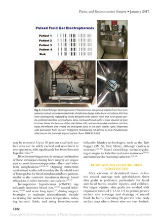 Copyright © 2016 American Society of Plastic Surgeons. Unauthorized reproduction of this article is prohibited.
128e
Plastic and Reconstructive Surgery • January 2017
may be removed. Up to 50 percent total body sur-
face area can be safely excised and resurfaced in
one operation, with significantly less blood loss and
hypothermia.108
Blood-conserving protocols using a combination
of these techniques during burn surgery are impor-
tant to avoid immunosuppressive effects and infec-
tious complications.105,109–112
Ongoing multicenter
randomized studies will elucidate the threshold level
ofhemoglobinforbloodtransfusioninburnpatients,
similar to the restrictive transfusion strategy found
efficacious in other intensive care patients.113–116
Intraoperative hypothermia (<36.0°C) sig-
nificantly increases blood loss,117,118
wound infec-
tion,119,120
and acute lung injury121
during surgery.
Strategies to maintain normothermia include
increasing the ambient room temperature, infus-
ing warmed fluids, and using forced-warm-air
inflatable blanket technologies, such as the Bair
hugger (3M, St. Paul, Minn), although caution is
necessary.122–125
Novel closed-loop thermoregulat-
ing strategies include thermal water mattresses126,127
and intravascular warming catheters.128–130
BURN WOUND CLOSURE: SKIN
SUBSTITUTES
After excision of devitalized tissue, defini-
tive wound coverage with split-thickness sheet
skin grafts is preferred, particularly for hand
and facial burns, smaller injuries, and children.
For larger injuries, skin grafts are meshed with
expansion ratios of 1:1.5 to 1:3 to permit greater
surface area coverage and drainage of wound
fluid. In burns exceeding 60 percent total body
surface area where donor sites are very limited,
Fig. 5. Pulsed field gel electrophoresis of Pseudomonas aeruginosa isolated from four burn
patients tracked to contaminated sinks of defective design in the burn unit (above, left) that
were subsequently replaced by newly designed sinks (above, right) that have splash pan-
els, polished stainless steel surfaces, deep contoured bowls with U-traps situated at least
6 inches below the bottom of the sink (below, left), and an ultraviolet irradiation cell that
treats the effluent and creates the blue/green color in the drain (below, right). (Reprinted
with permission from Elsevier: Tredget EE, Shankowsky HA, Rennie R, et al. Pseudomonas
infections in the thermally injured patient. Burns 2004;30:3–26.)
 