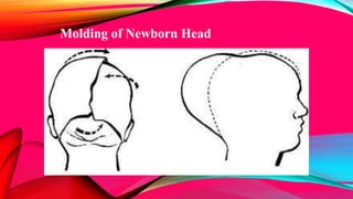 Molding of Newborn Head
 