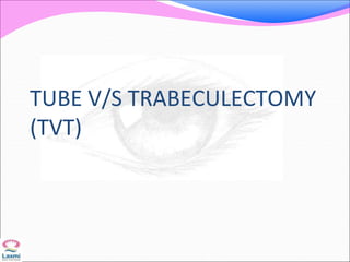TUBE V/S TRABECULECTOMY
(TVT)
 