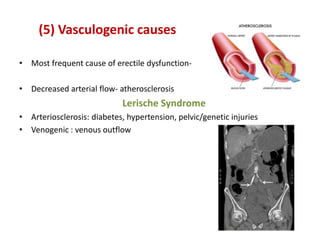 (5) Vasculogenic causes
• Most frequent cause of erectile dysfunction-
• Decreased arterial flow- atherosclerosis
Lerische Syndrome
• Arteriosclerosis: diabetes, hypertension, pelvic/genetic injuries
• Venogenic : venous outflow
 