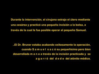..El Dr. Bruner estaba acabando exitosamente la operación, cuando  S a m u e l  s a c ó su  pequeñísima pero bien desarrollada  m a n o  a través de la incisión practicada  y  se a g a r r ó  del  d e d o  del atónito médico. Durante la intervención, el cirujano extrajo el útero mediante una cesárea y practicó una pequeña incisión a la bolsa, a través de la cual le fue posible operar al pequeño Samuel. 