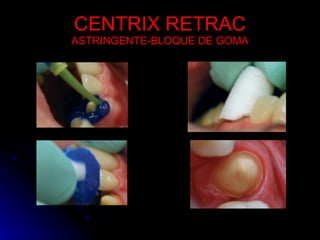 CENTRIX RETRAC ASTRINGENTE-BLOQUE DE GOMA 