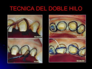 TECNICA DEL DOBLE HILO 
