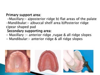 Posterior Ridge K-prosthodontic-lec2-Impression for complete denture | PPTX